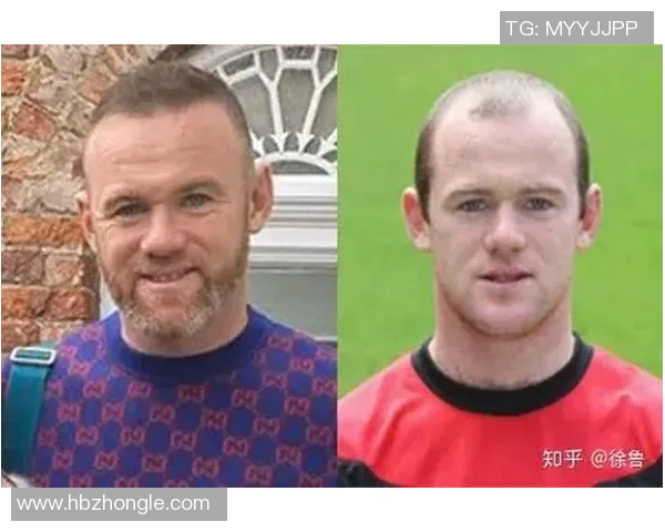 脱发问题困扰足球明星们的职业生涯与形象影响分析